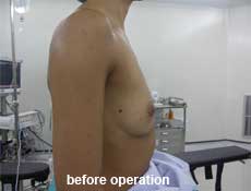 plastic-surgery-breast-augmentation 
